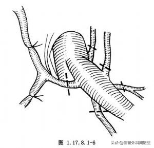 下肢静脉曲张教你正确防治,下肢静脉曲张血管外科