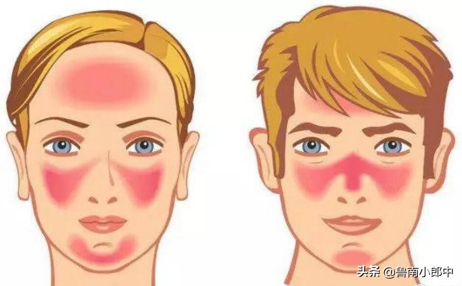 干燥泛红过敏了怎么办,脸部过敏泛红痒干燥起皮小妙招