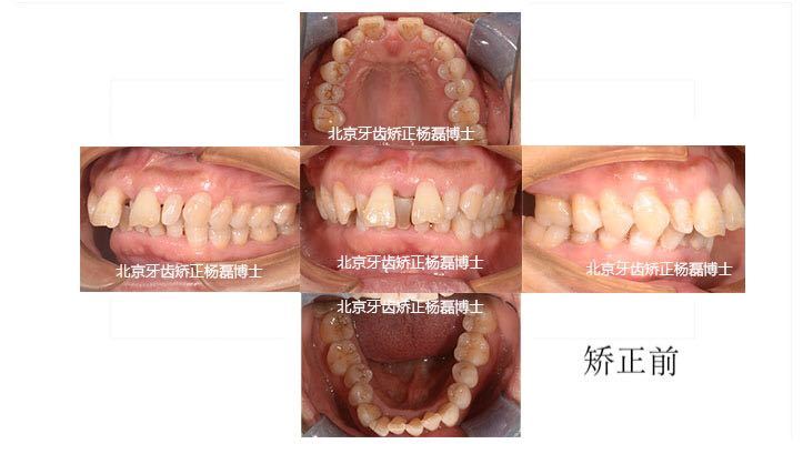 杨磊正畸医生,牙周病牙龈萎缩正畸案例