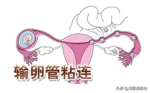 做输卵管造影扩开宫颈口疼吗,输卵管造影后肚子十几天还是疼