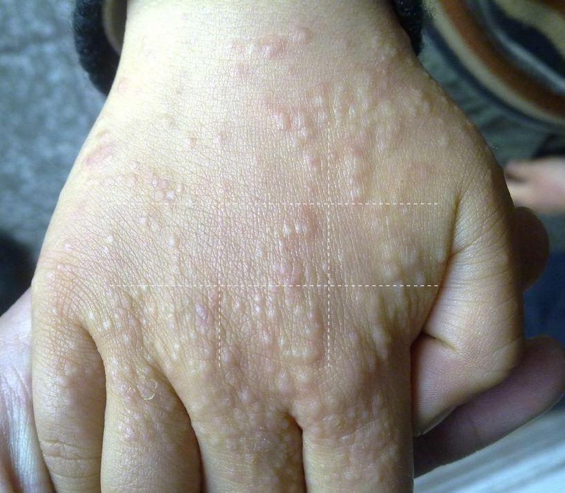 小朋友手上起了小丘疹,小孩手上有小丘疹是怎么回事