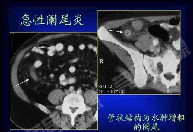 阑尾炎可以不做手术么,阑尾炎可以不做手术吗