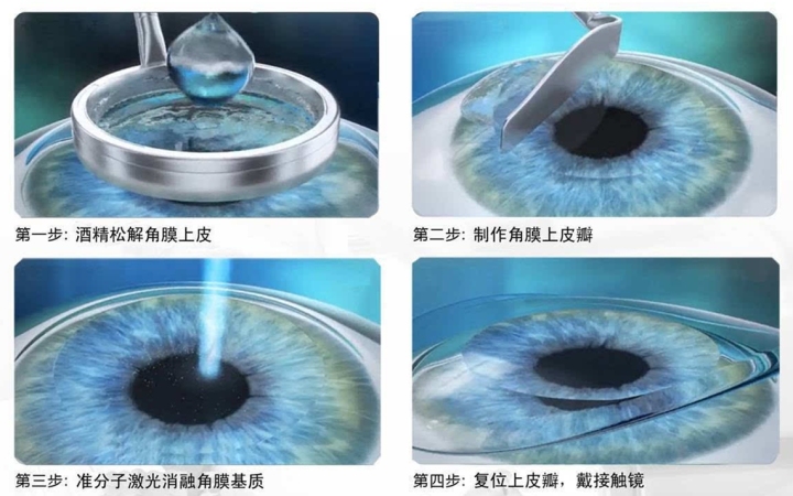 做半飞秒近视眼手术最坏的后果,近视眼手术最佳年龄和度数费用