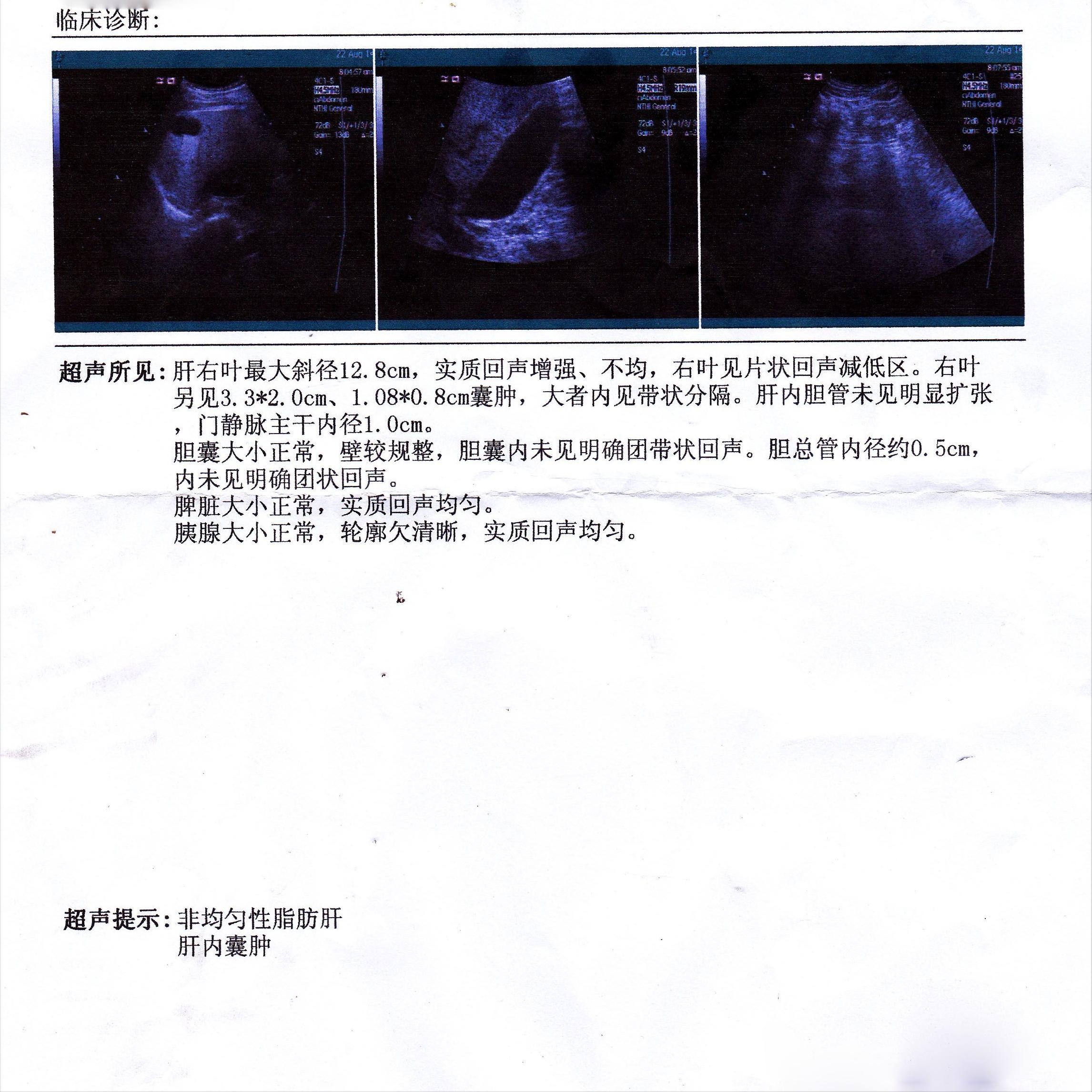 结节息肉囊肿增生哪个更容易癌变,结节囊肿增生息肉有什么区别