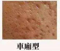 比激光更有效的祛痘坑方法,痘痘痘坑怎么消除