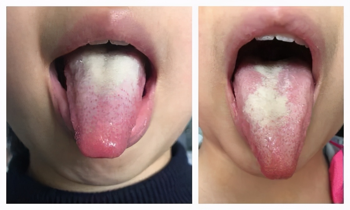 小儿怎么预防积食还能营养均衡,小儿百病积食为先