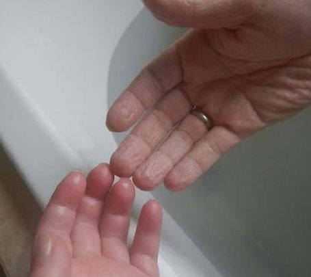 为什么手指泡水会有坑,手指为什么泡水特别容易烂