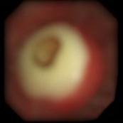 76岁老人咳嗽发烧6天，一查竟是「肺错构瘤」长在支气管里