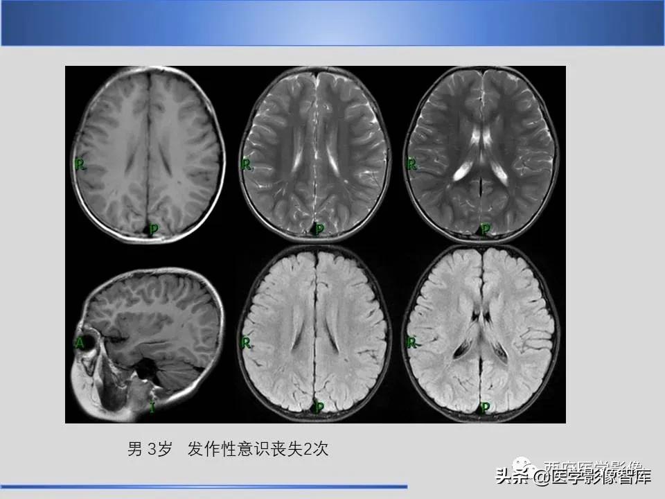 vr间隙概念,vr间隙需要做什么检查