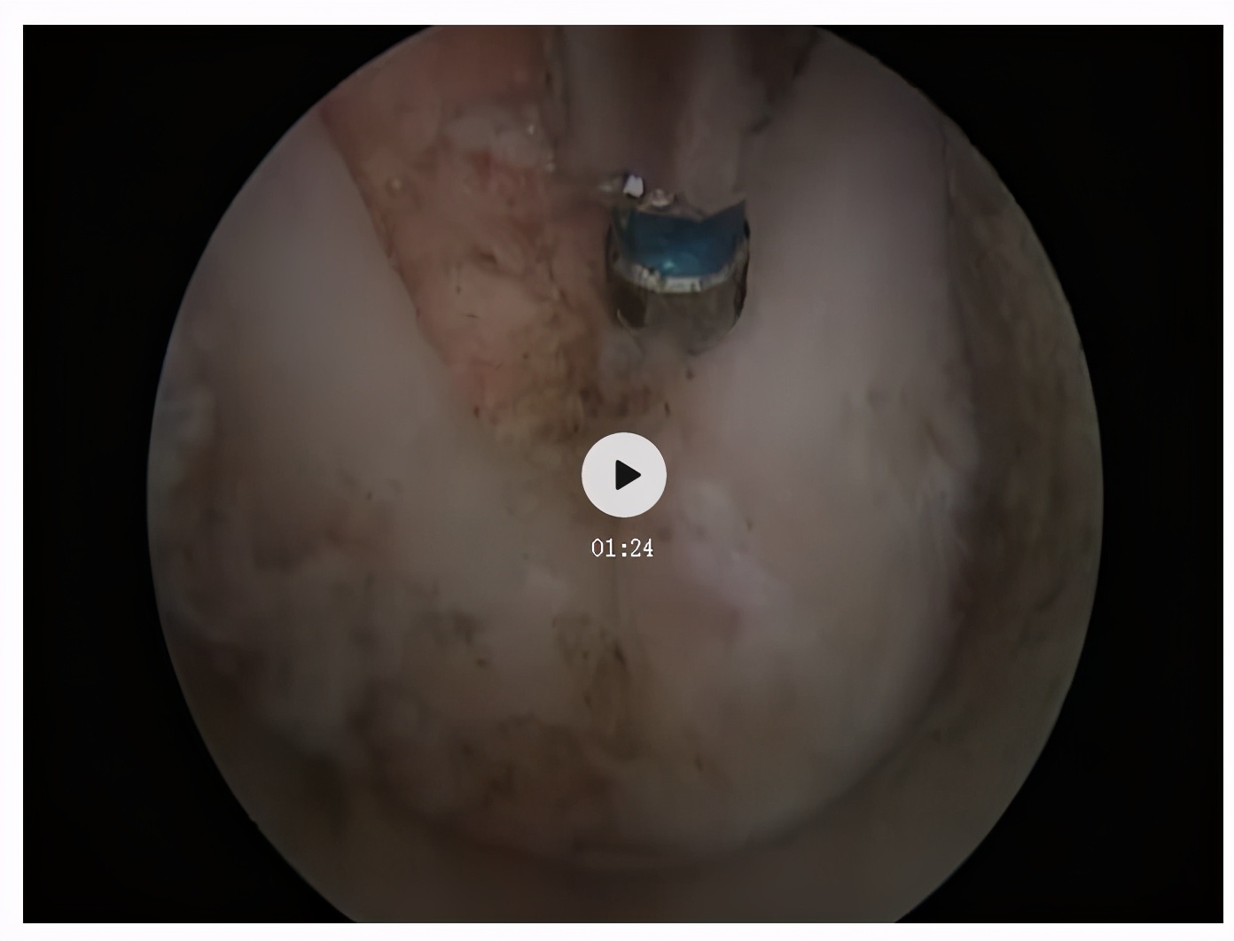 脊椎狭窄压迫神经腿疼怎么治疗,神经根痛上肢麻木怎么康复