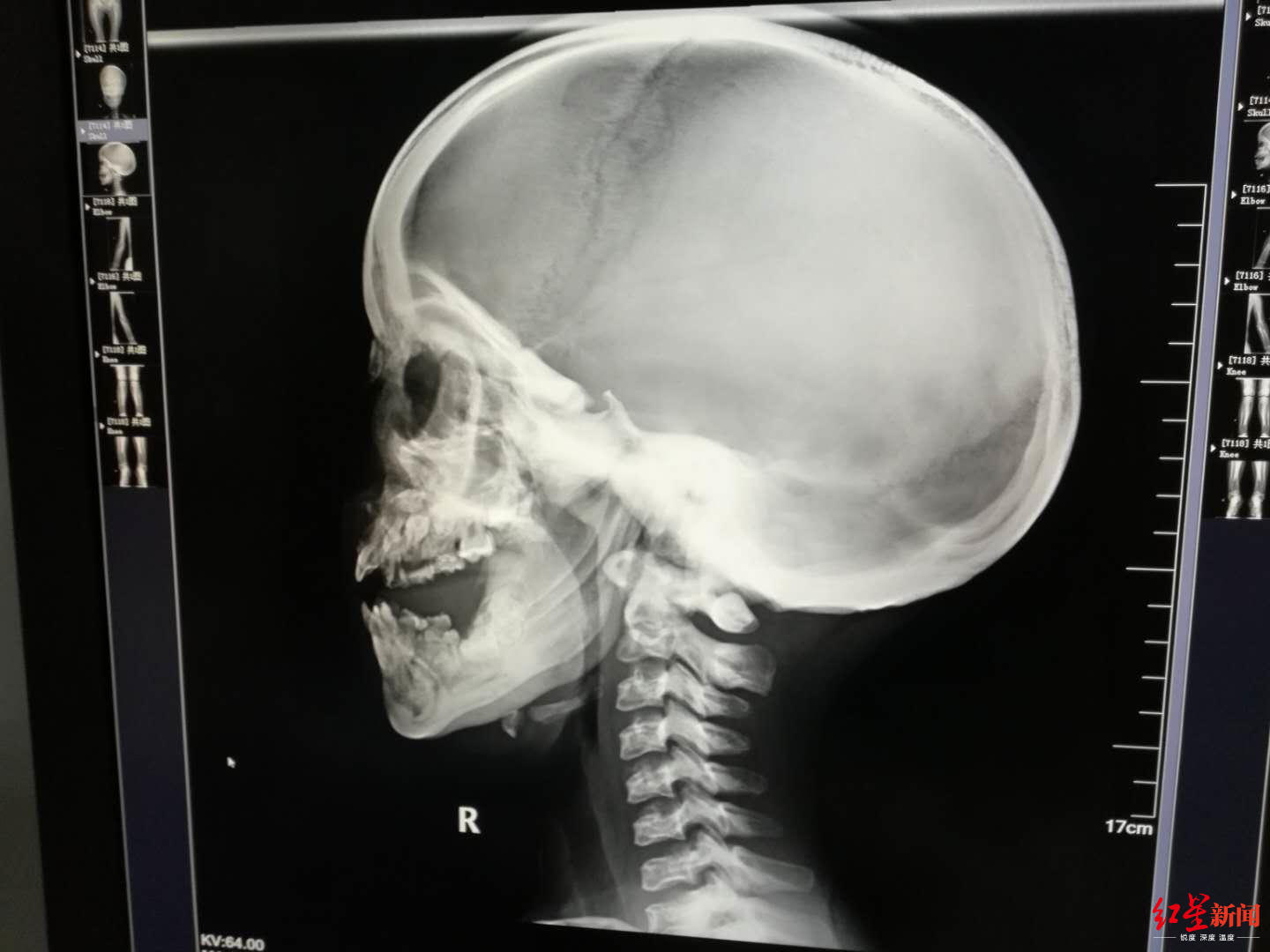 13岁女孩鼻窦炎能治好吗,女童13岁鼻窦炎不治会怎么样呢