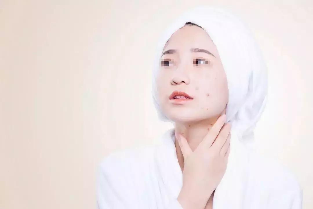 手把手教你正确挤痘不留坑,挤痘有个坑怎么补救