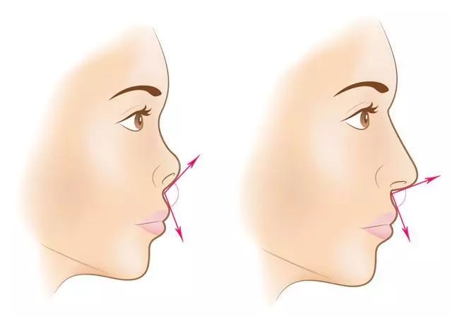 鼻型整容过程,如何缩鼻头鼻翼修容