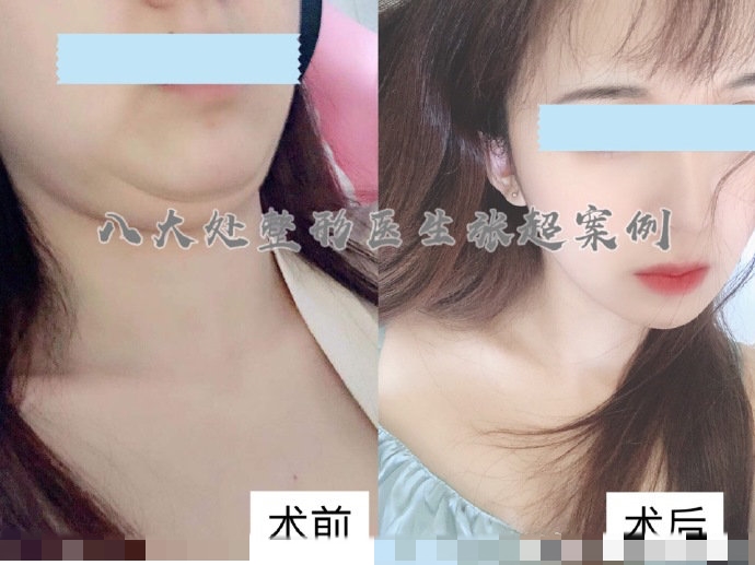 八大处整形张超,八大处张超最新视频