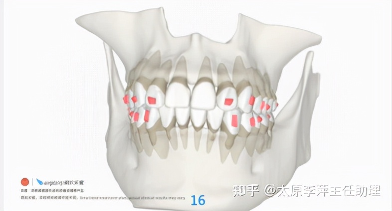 重度拥挤矫正牙齿适合隐形牙套吗,广州成人牙齿矫正推荐隐形牙套