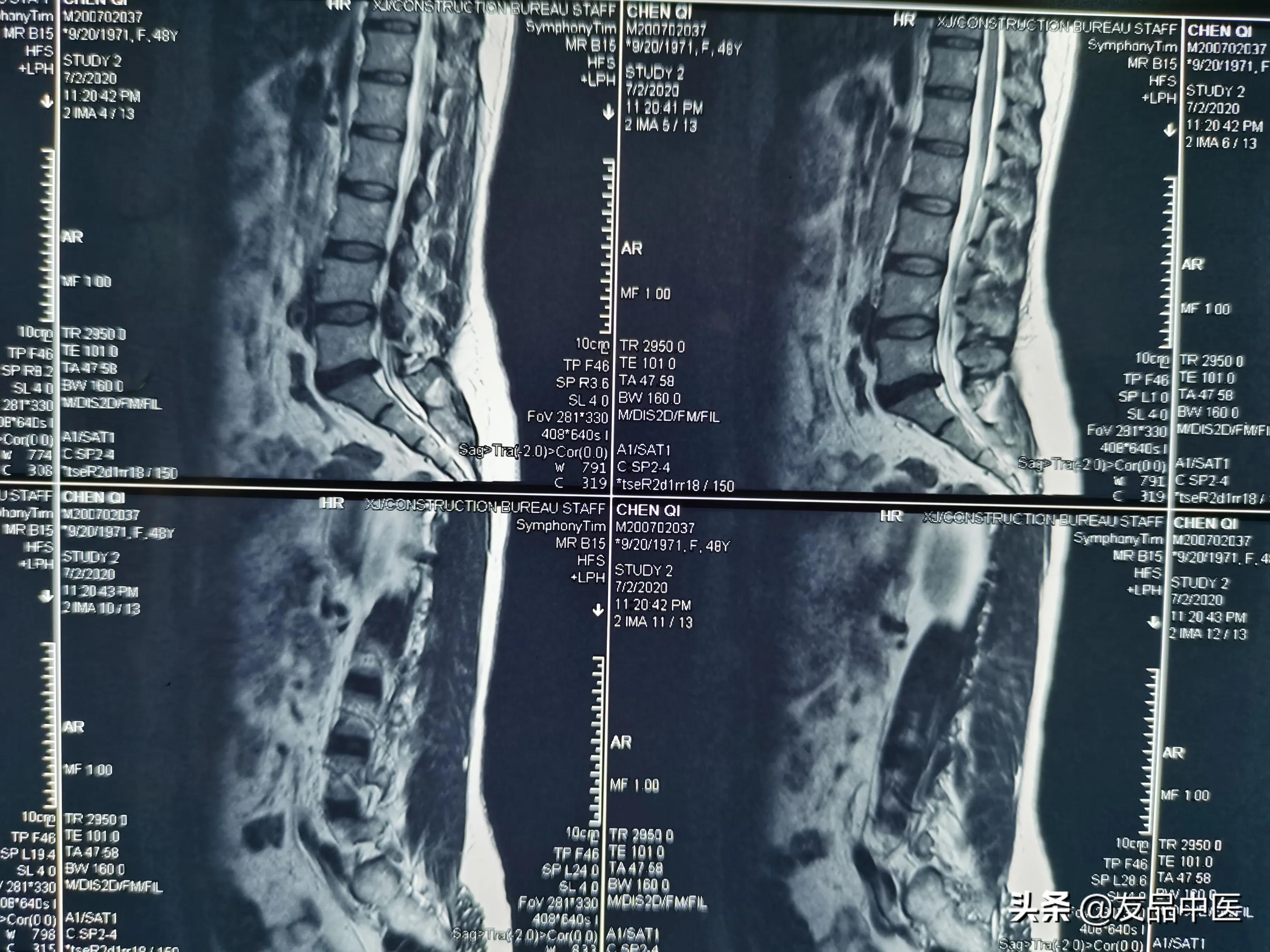 腰痛应该避免什么,腰痛你们是怎么治的