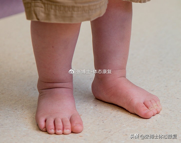 扁平足矫正的最佳年龄怎么矫正,扁平足的矫正方法舞蹈