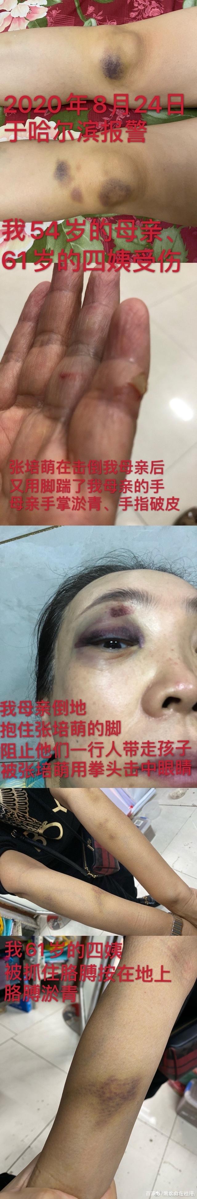 美女主播爆运动员丈夫孕期家暴还被拔指甲，男方甩锅激素太无语