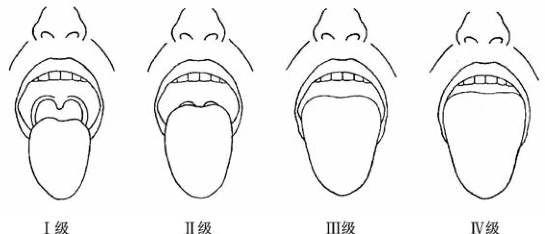困难气道插管视频,困难插管