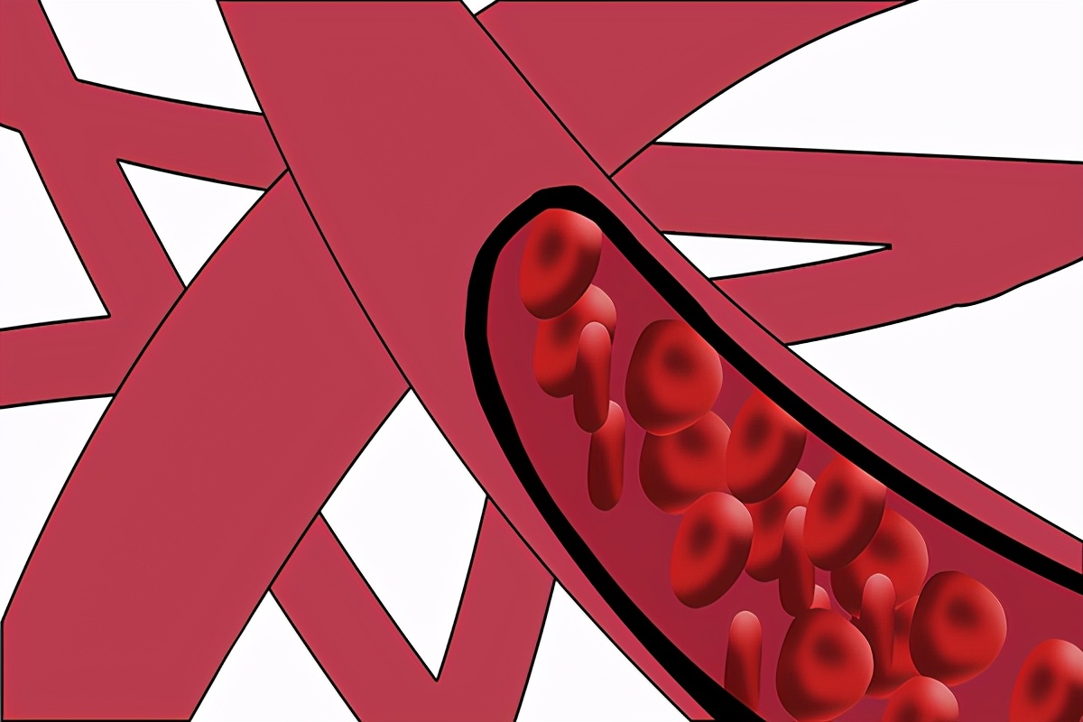 心肌缺血是冠心病的一种吗,心肌缺血是冠心病吗严重吗