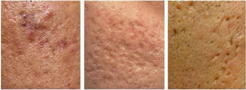 长痘留下的疤能消除吗,长痘留下的毛孔真的恢复不了了吗