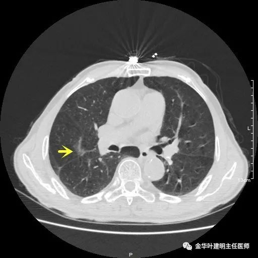多发原发肺癌能根治吗,肺部原发性恶性肿瘤好治