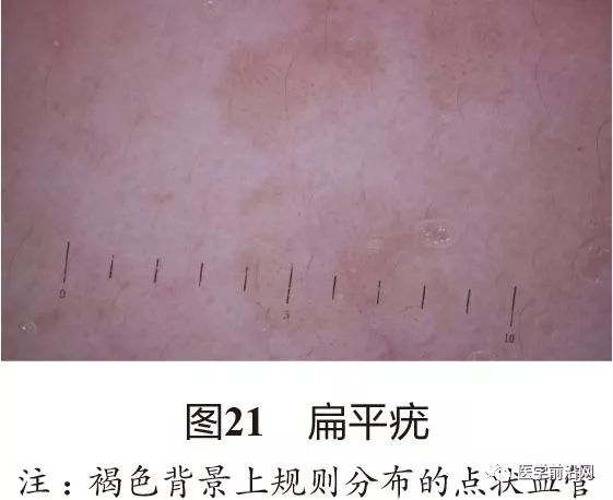 面部常见皮肤病皮肤镜诊断专家共识全文发布