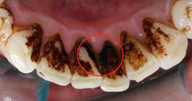 牙缝里黑色污垢是蛀牙吗,牙缝里黑垢能洗掉吗
