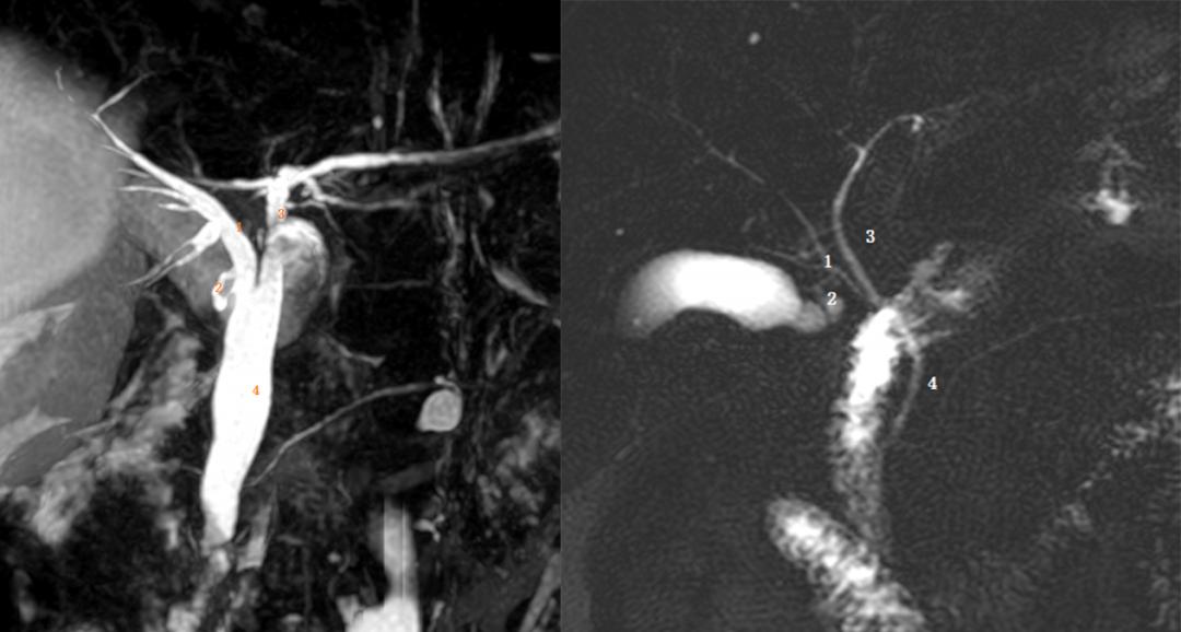 胆囊变异解剖图,胆道血供解剖