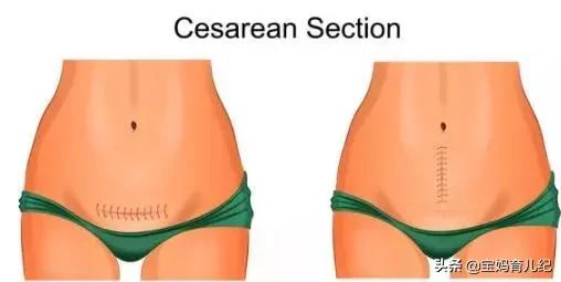 蔡少芬开刀生孩子第二天就下床：做好这些你也可以