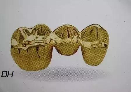 换一副烤瓷牙什么材料比较好,各类烤瓷牙材料的优缺点对比