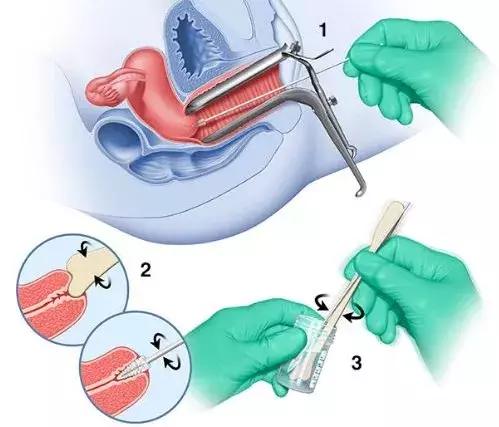 宫颈涂片能够有效筛查宫颈癌吗,宫颈癌筛查冲洗