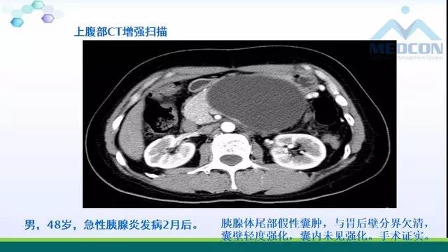 急性胰腺炎的护理措施,急性胰腺炎影像与临床