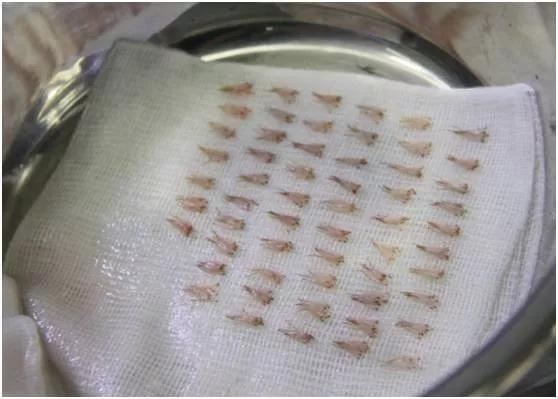 m型脱发临床诊断怎么写,m型脱发最新研究