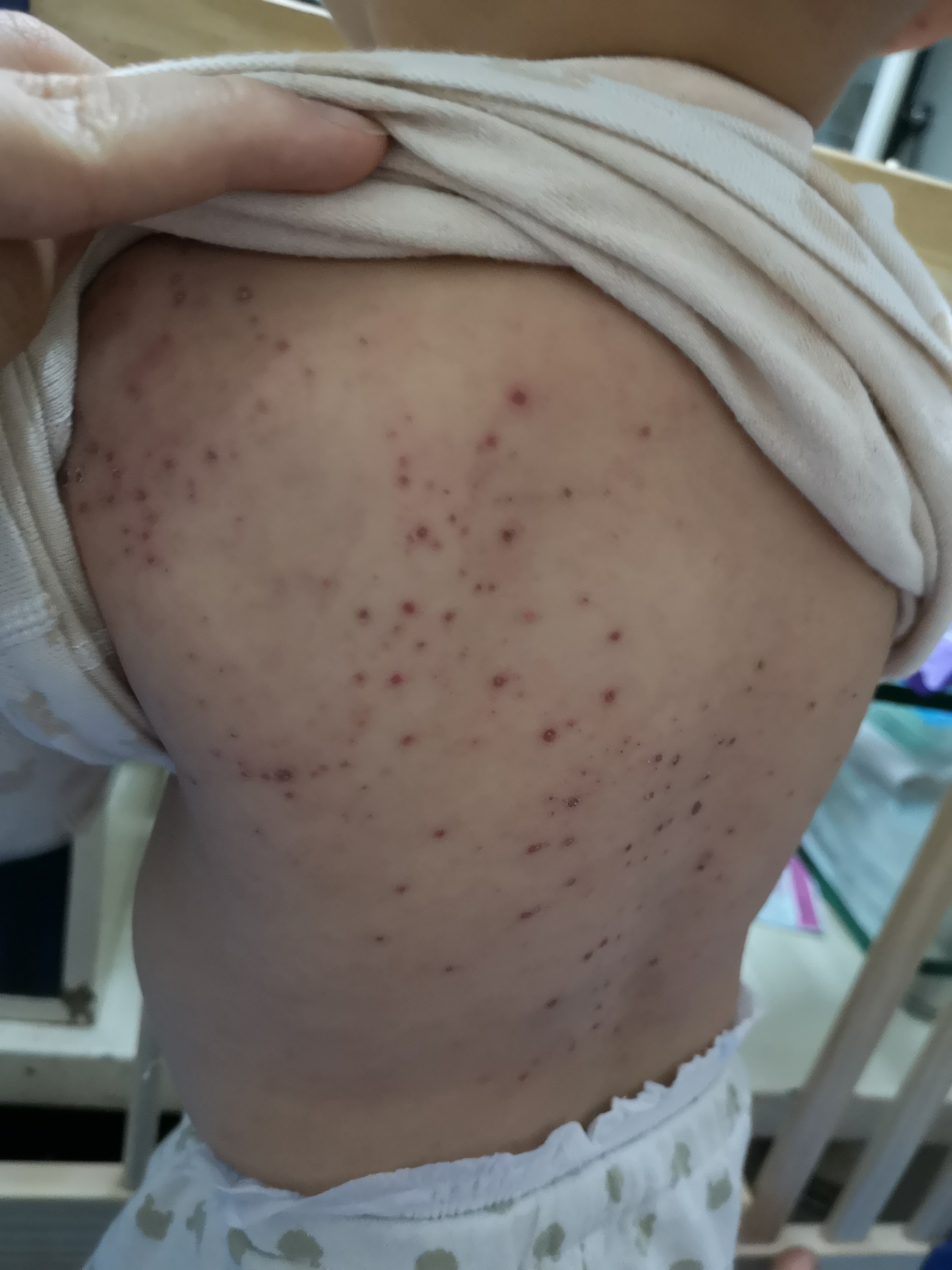 手足口疱疹性咽颊炎进入高发期,手足口高发期孩子有什么症状