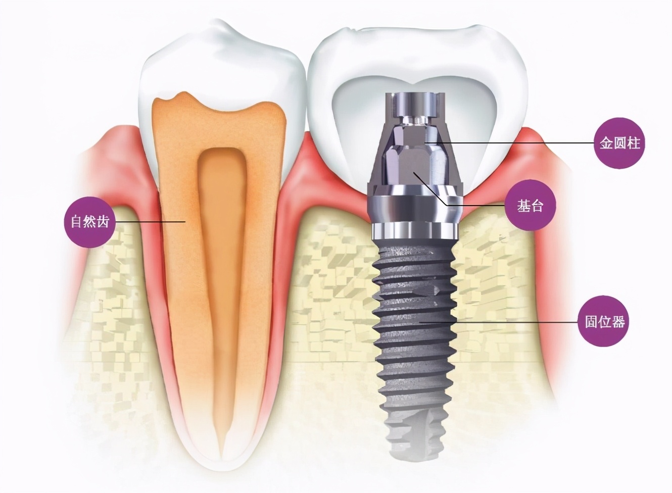 雅悦齿科种植牙价格表,雅悦齿科儿童护牙