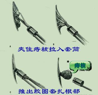 内痔套扎疗效好，并发症少，是国际公认最佳的门诊治疗方法