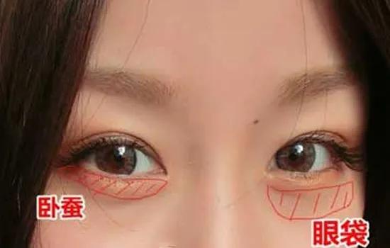 卧蚕整形可以去眼袋吗,眼袋和卧蚕整形前后对比