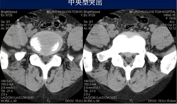 腰椎管狭窄的磁共振诊断标准,腰椎轻度退行性变化椎间盘膨出