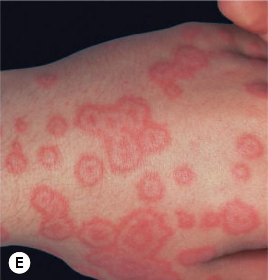 过敏性紫癜算是风湿病的一种吗,风湿性关节炎与过敏性紫癜区别