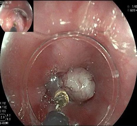 贲门处见隆起性病变,贲门高级别瘤变esd术后不能吃什么