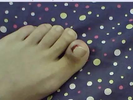 甲沟炎经验分享,甲沟炎的自愈经历