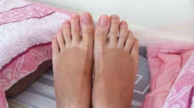 夏天了手脚干裂还有老茧,手脚干裂脱皮老茧用什么药膏