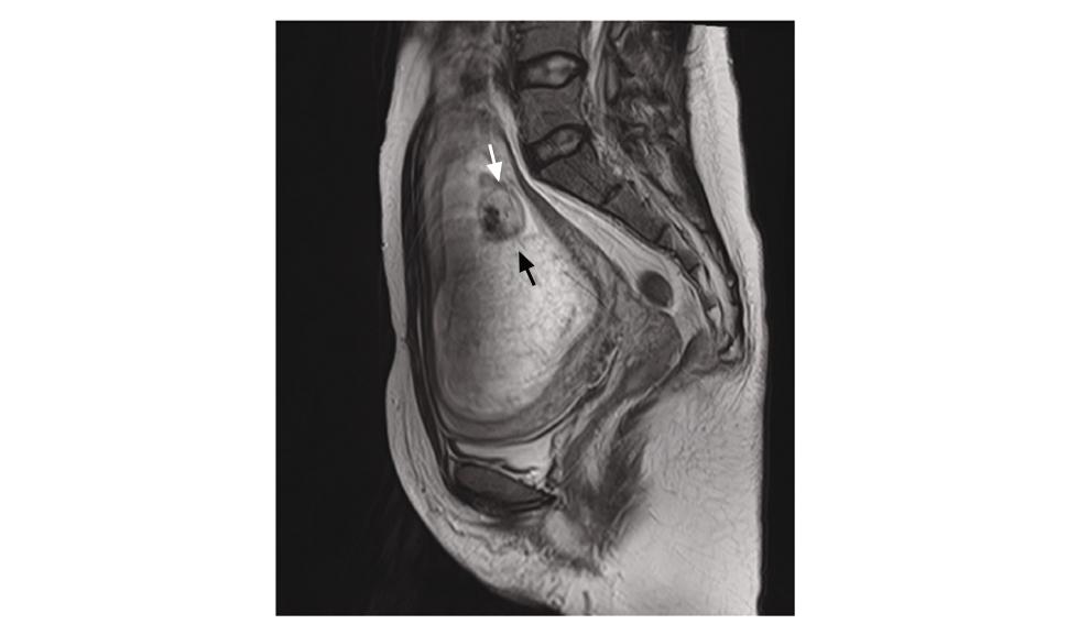 极为罕见！怀了双胞胎，却有一个是葡萄胎？高龄宝妈葡萄胎16周成功引产于阴道分娩
