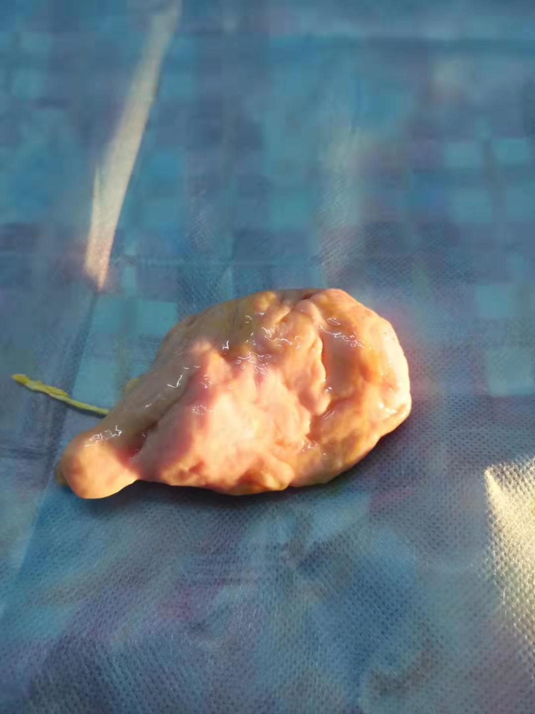 子宫肌瘤微创后月经量大有血块,严重贫血子宫肌瘤手术风险大不大