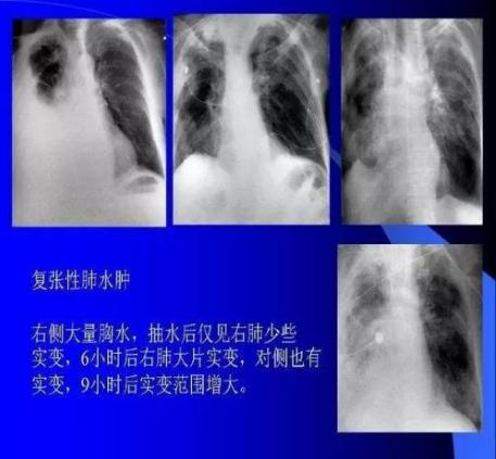 肺气肿与肺水肿中医理论,汉邦中医视频全集