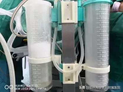 妇产科完成一例经脐单孔腹腔镜下巨大盆腔包块切除术