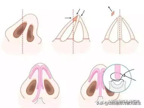隆鼻的真实感受男生,男生隆鼻和女生的区别