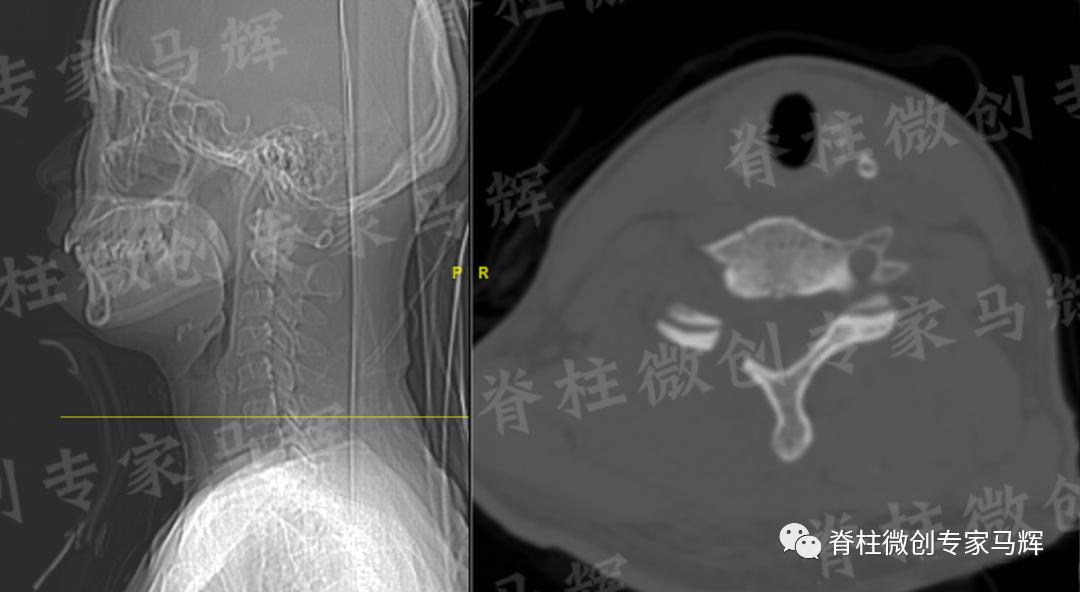 脊椎狭窄压迫神经腿疼怎么治疗,神经根痛上肢麻木怎么康复