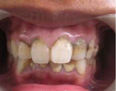 松了的牙齿好痒怎么办,松了两年的牙齿还可以补救吗